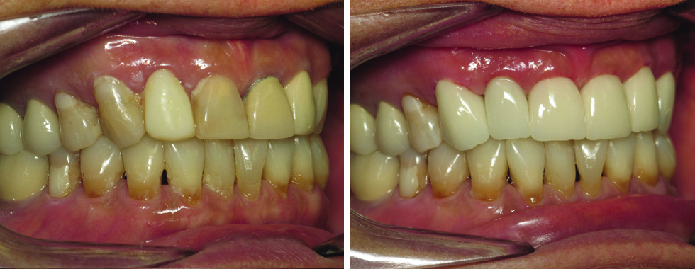Replacing older, discolored crowns. 67 years old.