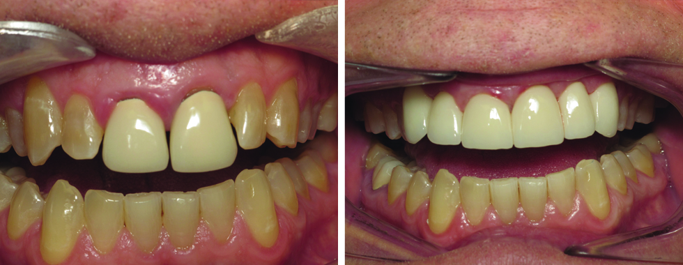 Replacing old porcelain crowns and remaking the adjacent teeth