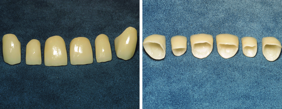 All-porcelain crowns out of the mouth