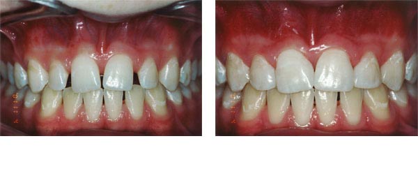 Closing spaces with composite.