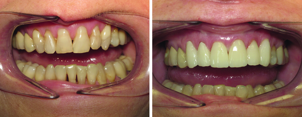 All porcelain crowns to greatly improve esthetics
