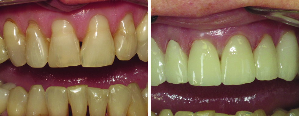 6 all porcelain crowns