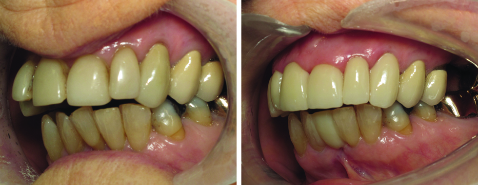 All- porcelain crowns to replace old, stained veneers (and straighten the teeth at the same time).