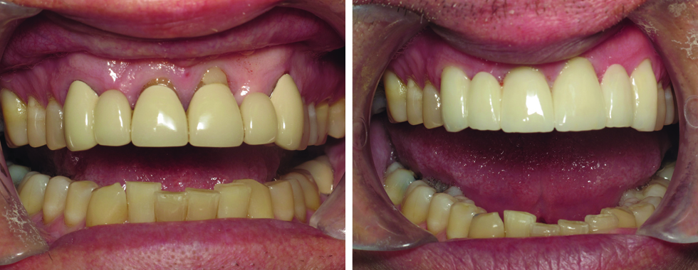 All-porcelain bridgework to replace very old bridges.