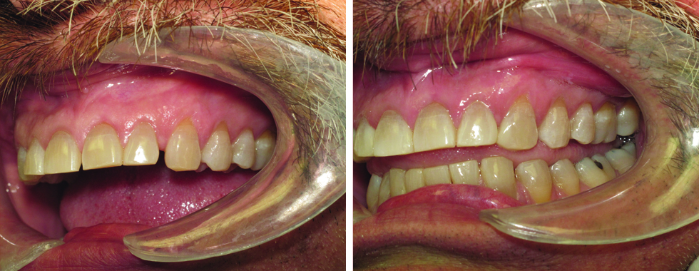 Composite bonding to close spaces on anterior teeth. Very non-invasive. No anesthetic required