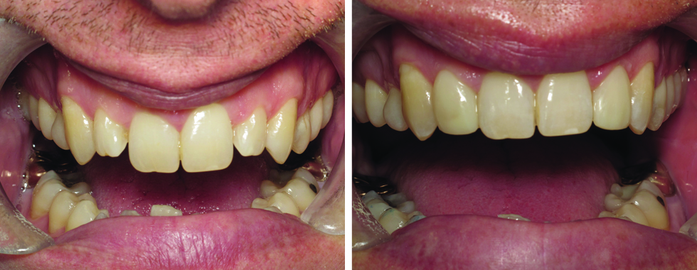 Making small, short lateral incisors look more esthetic. Composite bonding.
