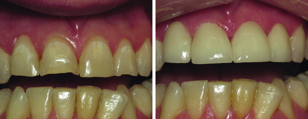 4 all-porcelain crowns to repair fractured incisors.