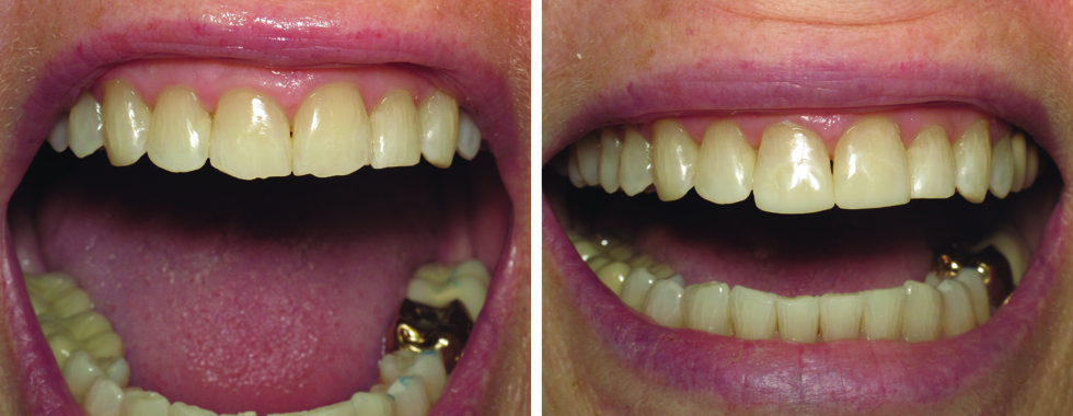 Repair of fractured incisal edges with composite.