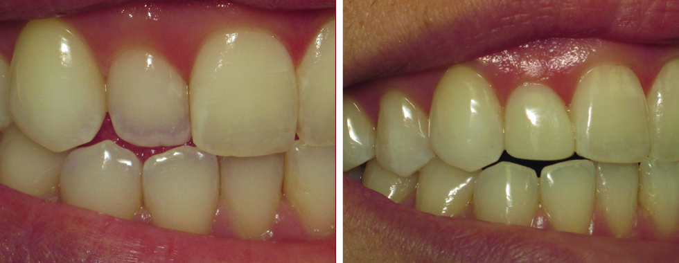 A single composite veneer to make lateral incisor "blend in" better with adjacent teeth.