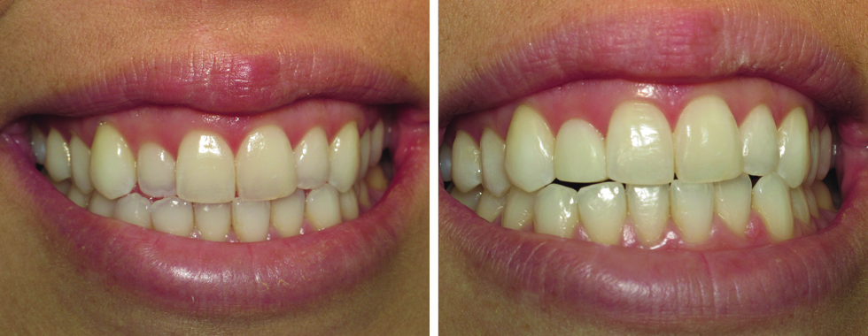 A single composite veneer to make lateral incisor "blend in" better with adjacent teeth.