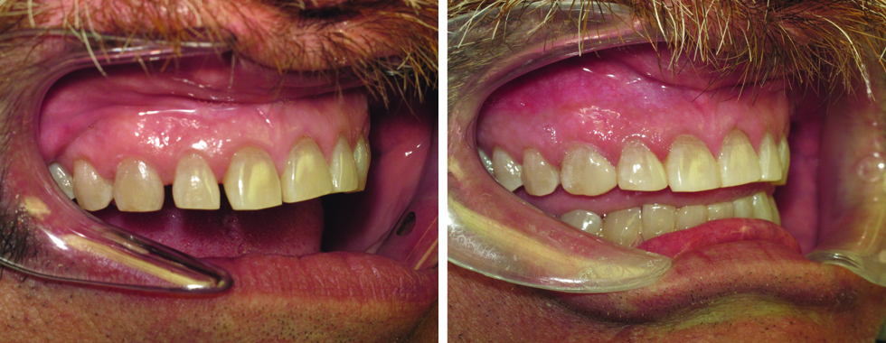Composite bonding to close spaces on anterior teeth. Very non-invasive. No anesthetic required
