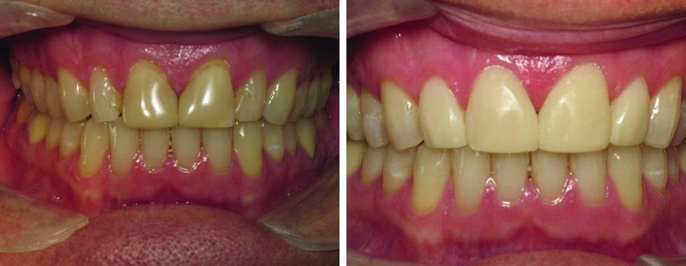 4 composite veneers to replace older, stained veneers. One appointment.