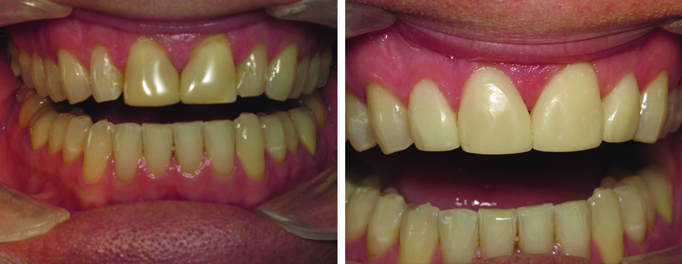 4 composite veneers to replace older, stained veneers. One appointment.