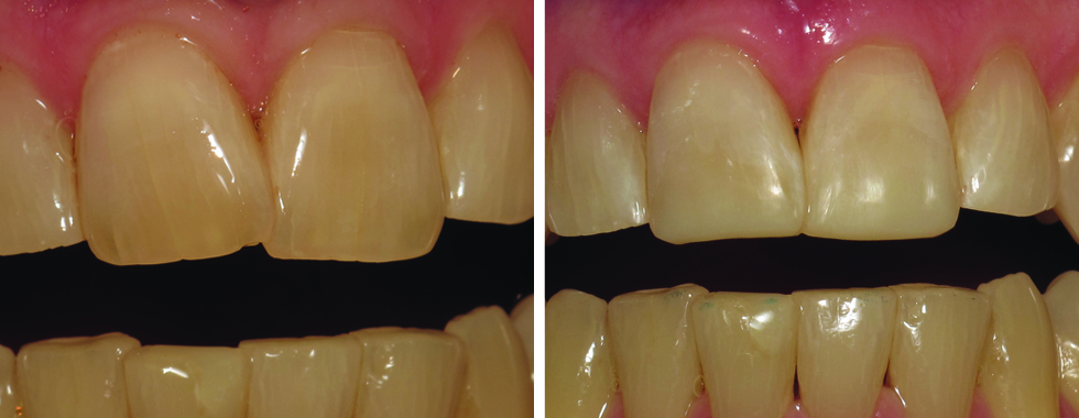 Composite repair of central incisors