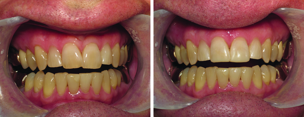 Composite repair of central incisors