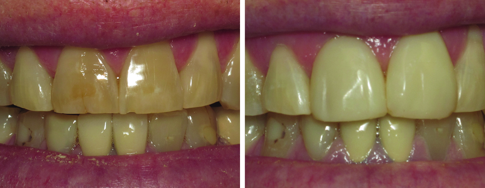 Composite veneers on 2 central incisors to cover worn and severely stained teeth.