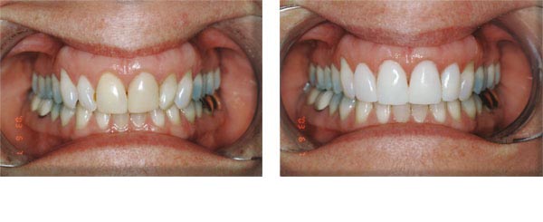 Old, discolored veneers and fillings were replaced with composite veneers. 1 appointment.