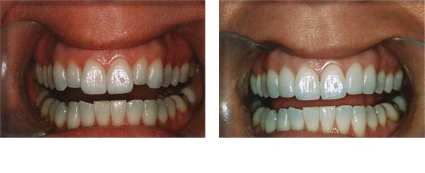 Composite veneers to lengthen the short lateral incisors and make the central incisors not look so 'big'.