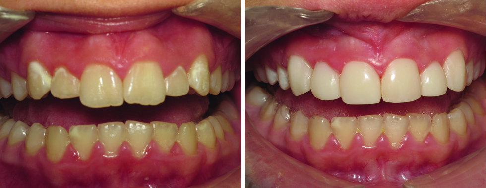 6 composite veneers